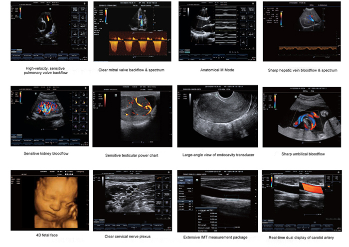 Superb ultrasound images by ES250 digital portable color Doppler ultrasound machine